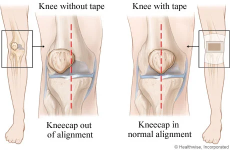 Knee out on sale of alignment